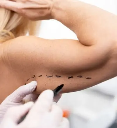 Braquioplastia: Cirurgia plástica no braço - Remoção de pele e flacidez