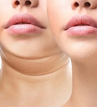 Mentoplastia: Cirurgia plástica no queixo