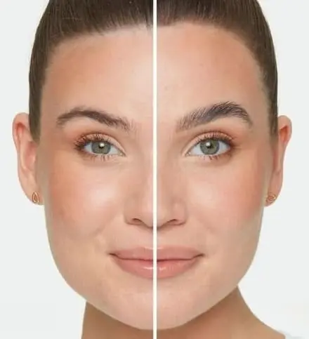 Brow Lifting - Cirurgia plástica nas sobrancelhas - Levantar sobrancelhas