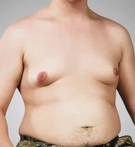 ginecomastia peitoral masculino