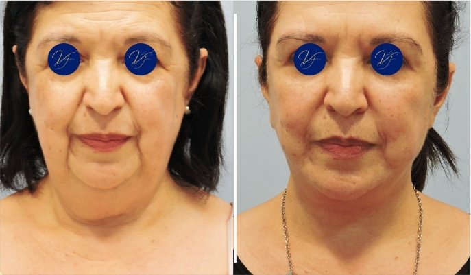 Necklifting: Lifting de pescoço antes e depois